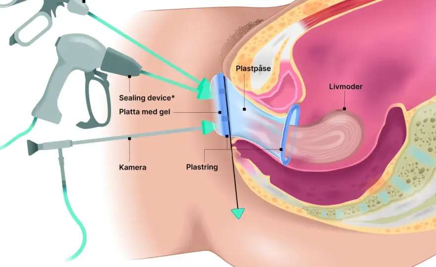 Vaginal åtstramning - vad som faktiskt fungerar