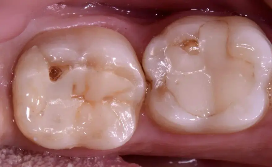 Buco nel dente senza carie? Le 6 cause e cosa fare
