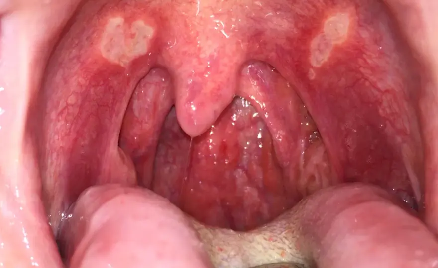Afta al palato - come distinguerla da herpes e candidosi