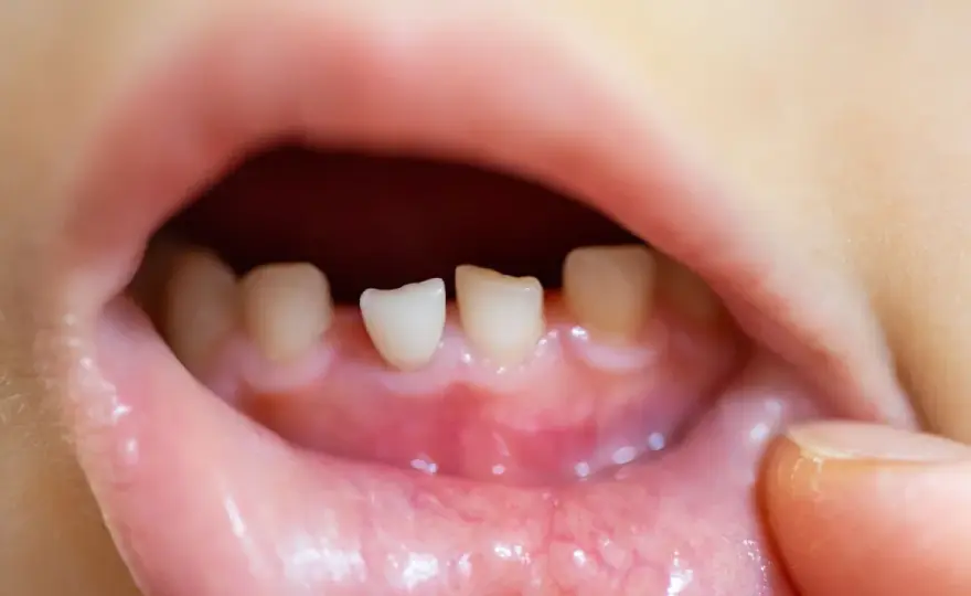 Dentizione e febbre nei bambini - quando preoccuparsi?