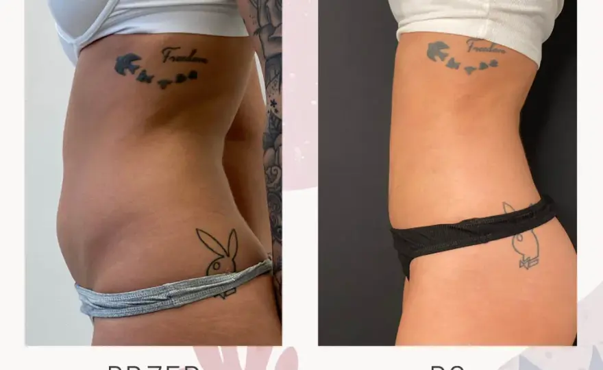 Liposukcja brzucha: Ile kosztuje? Pełny cennik i ukryte wydatki