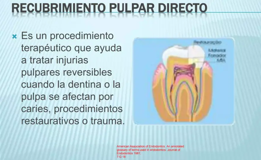 Recubrimiento pulpar, cuándo puede evitar la endodoncia