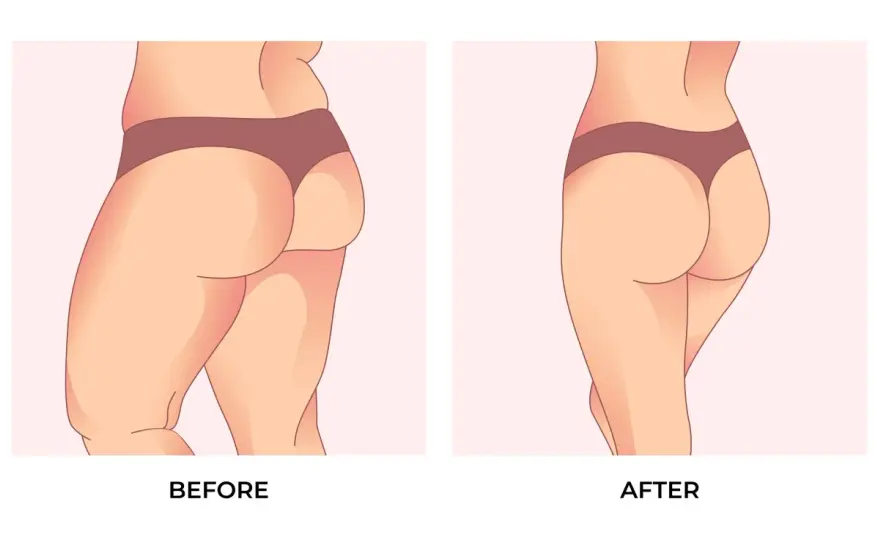 Vad betyder BBL? Allt om Brazilian Butt Lift & risker