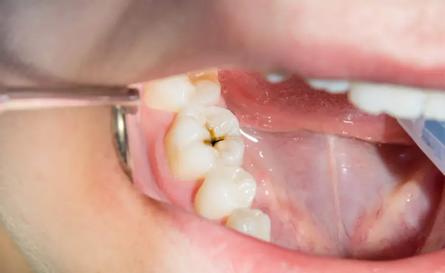 ¿Por qué salen caries aunque te cepilles? Claves para prevenirlas