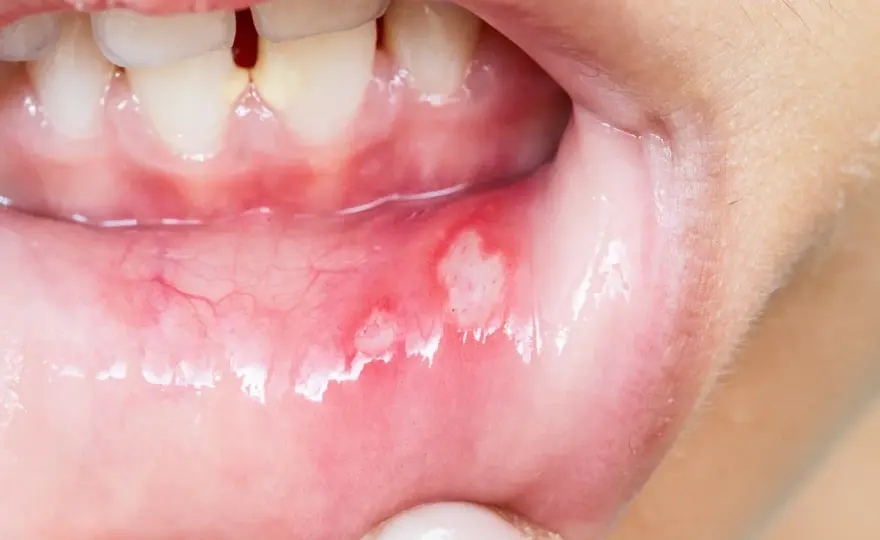 Afte, herpes eller stress i munnen? Få svar och lindring