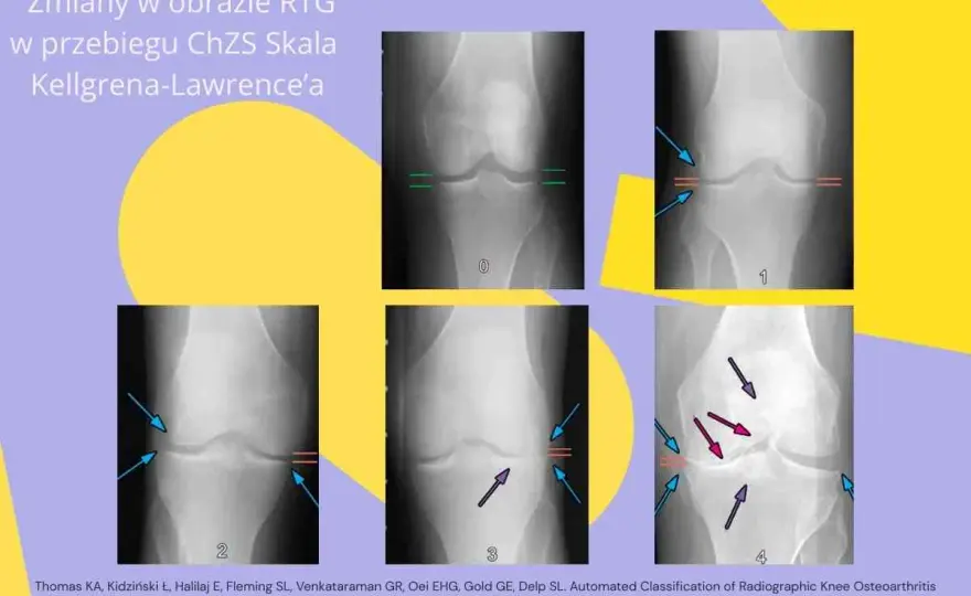 Choroba zwyrodnieniowa: Czy Cartexan to rozwiązanie dla Twoich stawów?