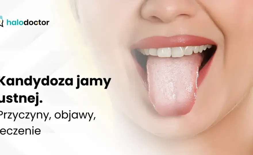 Kandydoza jamy ustnej: objawy, przyczyny i kiedy iść do lekarza
