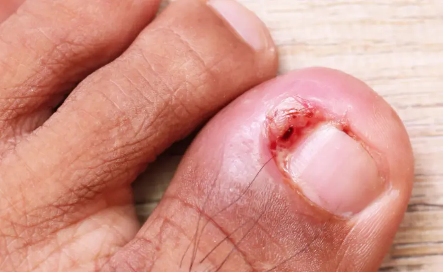 Unghia incarnita nel bambino - quando preoccuparsi?