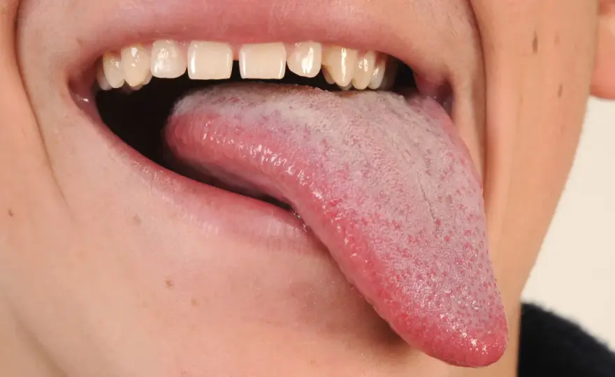 Granos en la lengua, causas comunes y cuándo consultar
