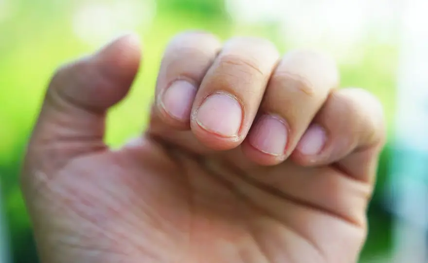 Trockene Fingerhaut - Ursachen, Pflege & wann zum Arzt?