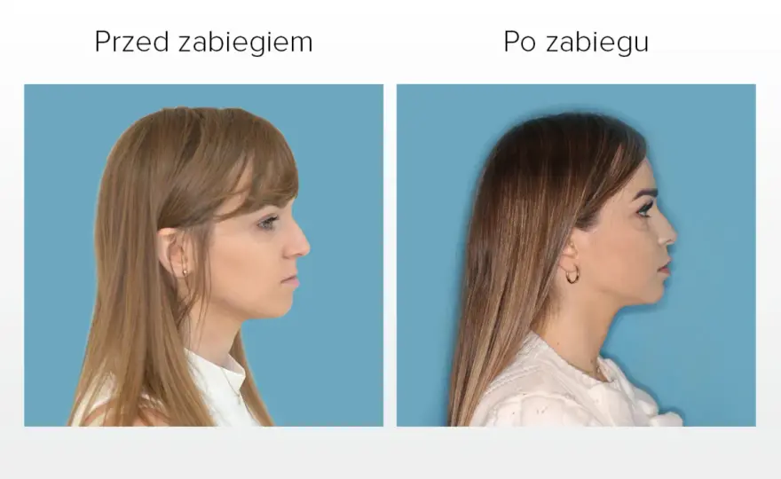 Asymetria szczęki i żuchwy - kiedy to wada, a kiedy uroda?