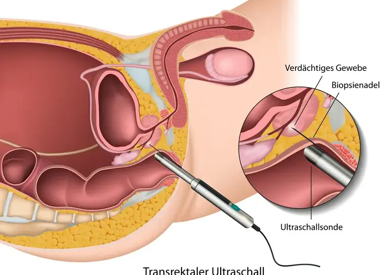 Wichtige Informationen zur Vorsorge Prostatakrebs: Tests und Empfehlungen