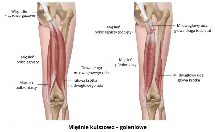 Ból podudzia - jak odróżnić przeciążenie od stanu pilnego?