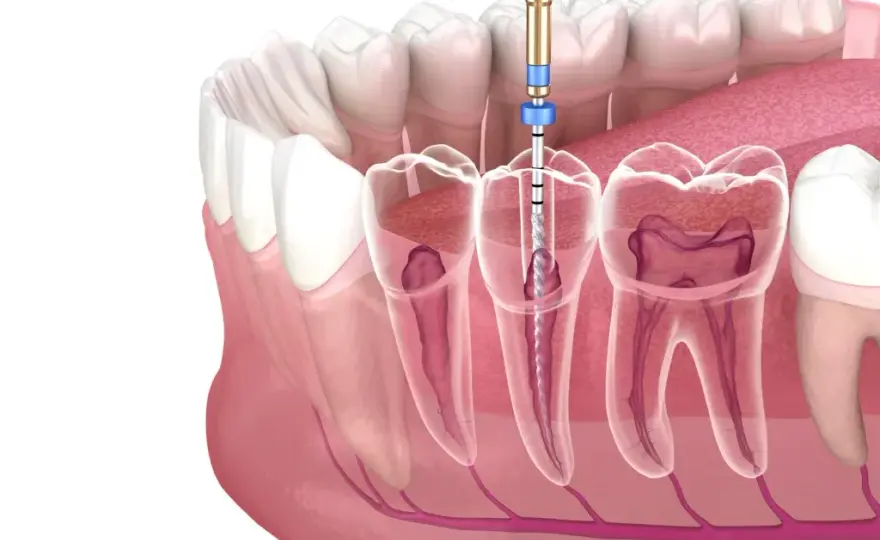 Jak bezpiecznie usunąć ząb? Kiedy dentysta, a kiedy domowe sposoby?