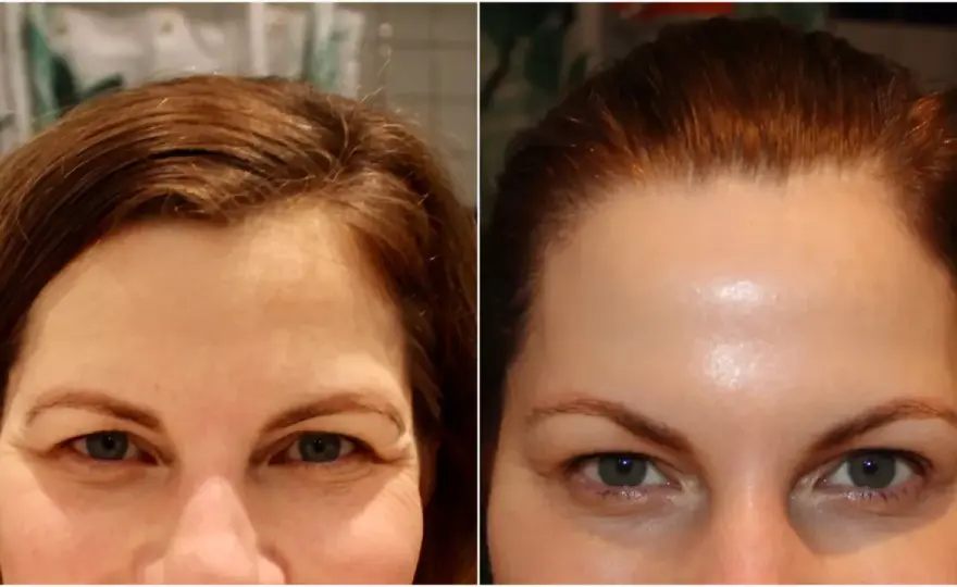 Bekymmersrynkan utan botox - Fungerar det? Din guide!