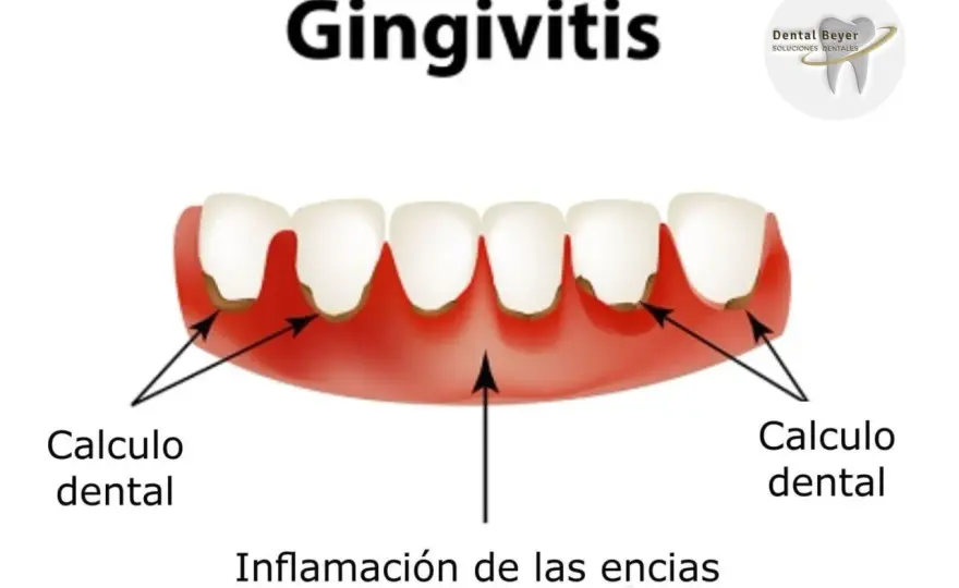 Gingivitis grave - señales de alarma y tratamiento