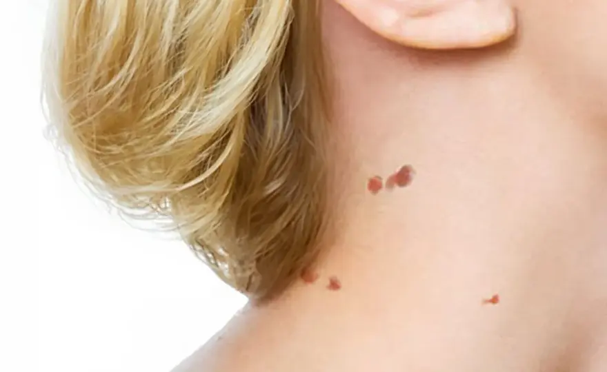 Acrochordon, comment l’enlever sans abîmer la peau ?