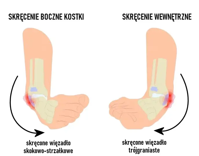 Ile leczy się skręcenie kostki? Poznaj skuteczne metody rehabilitacji