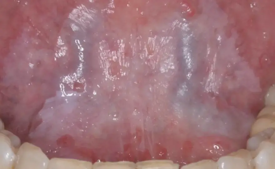 Leucoplasia de la lengua - causas y cuándo consultar