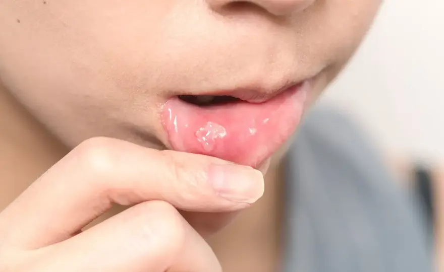 Cómo tratar la estomatitis según la causa y cuándo consultar