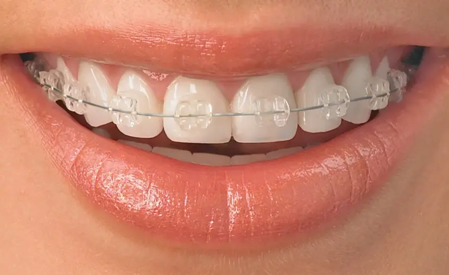 ¿Qué dientes necesitan brackets y cuándo convienen?