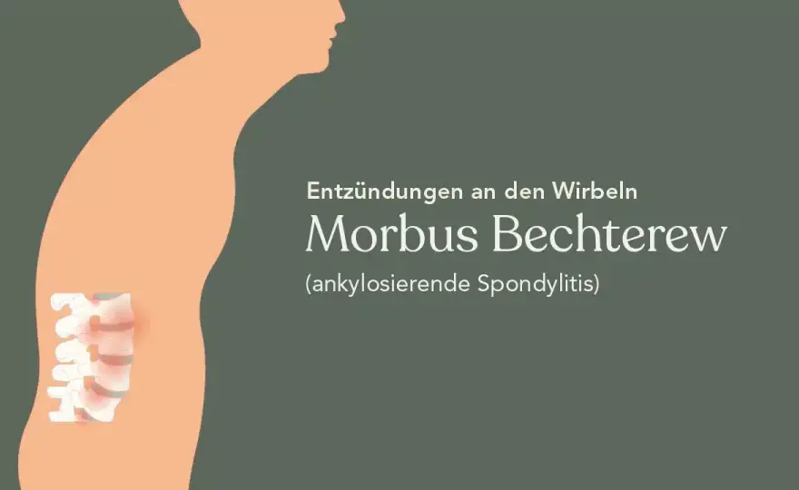 Die entscheidenden Schritte zur Diagnostik von Morbus Bechterew
