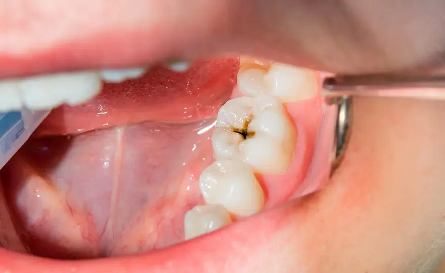 ¿Agujero en la muela del juicio? Cómo saber si es caries