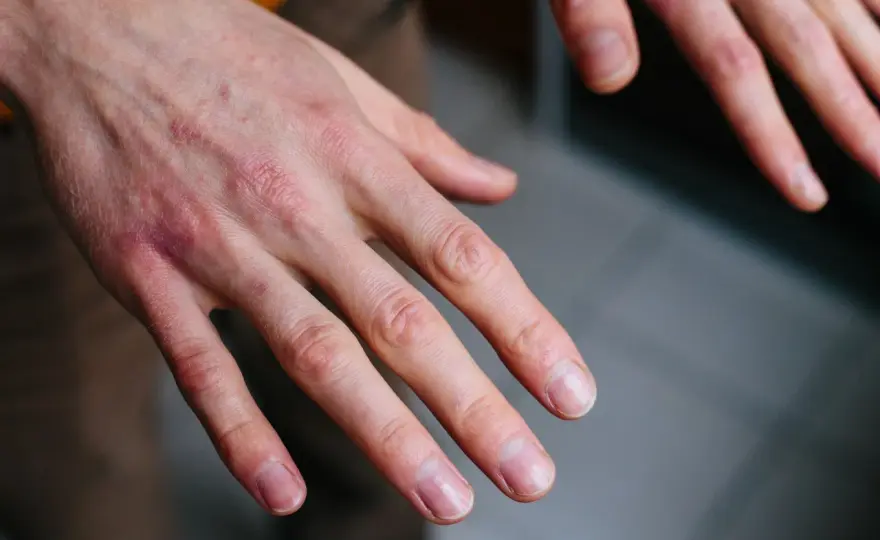 Sabañones en las manos: alivio y prevención eficaz
