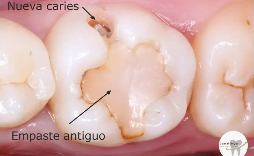 ¿Se te ha caído un empaste? Qué hacer y cuándo acudir al dentista