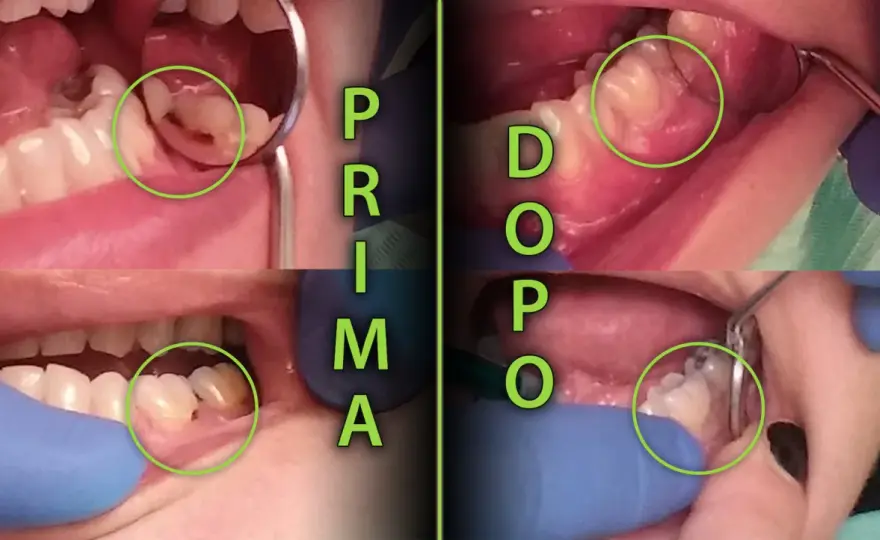 Carie del colletto dentale - segnali, cure e prevenzione