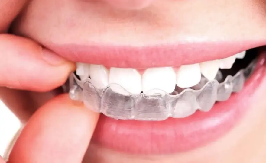 ¿Duele Invisalign? Cuánto dura la molestia y cómo aliviarla