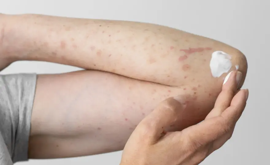 Pollenallergie und Hautausschlag - woran Sie ihn erkennen