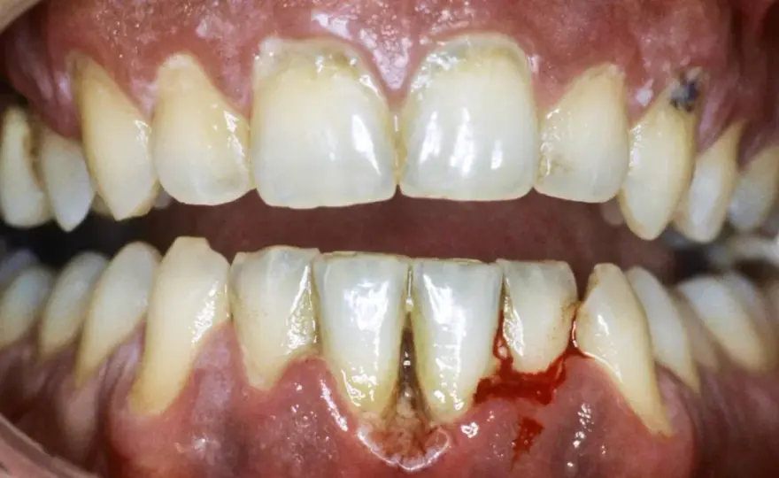 Gengive e denti doloranti - Cause e cosa fare subito