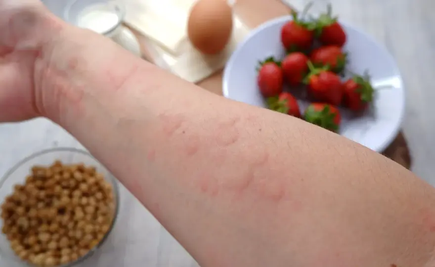 Wysypka po jedzeniu - Alergia czy nietolerancja? Sprawdź!