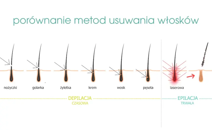 Elektroepilacja: Jedyna trwała depilacja dla każdego włosa?