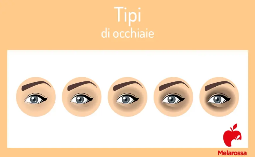 Occhiaie Nere - Cause, Tipi e Rimedi Efficaci: La Guida Completa