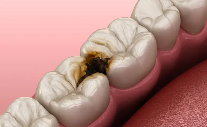 Carie profonda - Salva il tuo dente: sintomi, cure e prevenzione