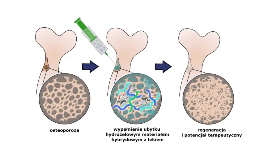 Leki na osteoporozę - które działają i kiedy je wybrać?
