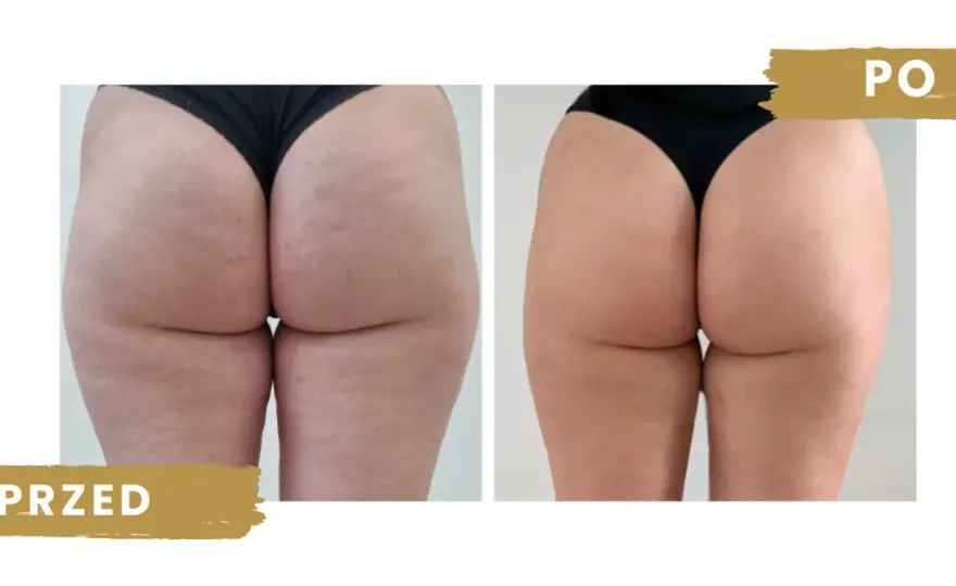 Endermologia czy warto? Szczera ocena efektów, kosztów i ryzyk.