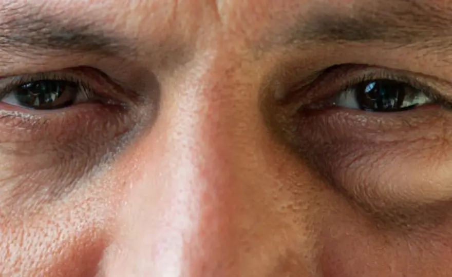Geschwollenes Auge - was hilft und wann es zum Arzt geht