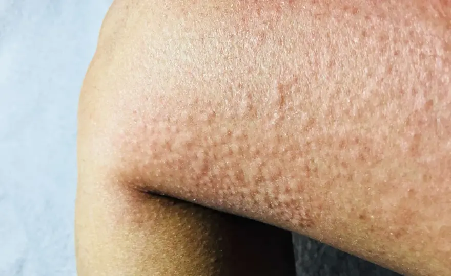 Orticaria, cosa fare e quando chiamare il 112