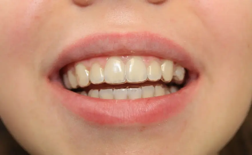 Efekty aparatu Invisalign - Kiedy zobaczysz zmiany?