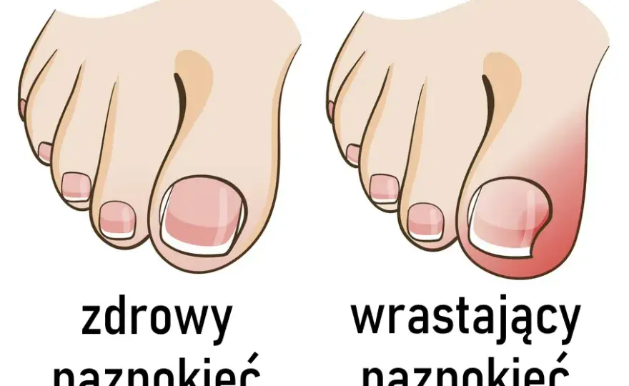 Jak wyciąć wrastający paznokieć i uniknąć bólu oraz powikłań