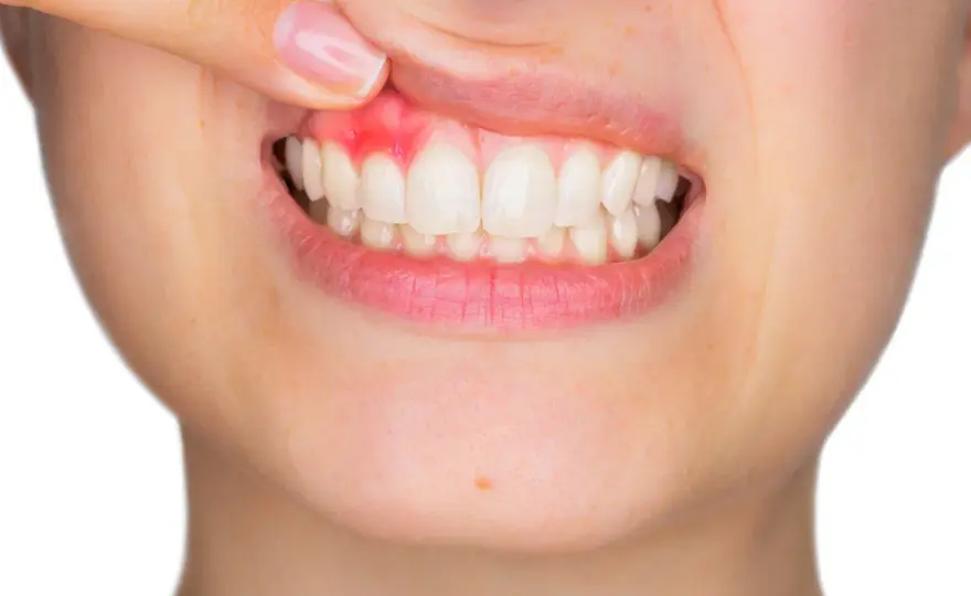 Piorrea curabile? Come fermare la parodontite e proteggere i denti