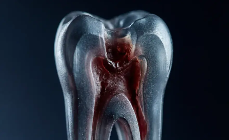 Ascesso dentale - segnali, urgenza e cosa fare prima della visita