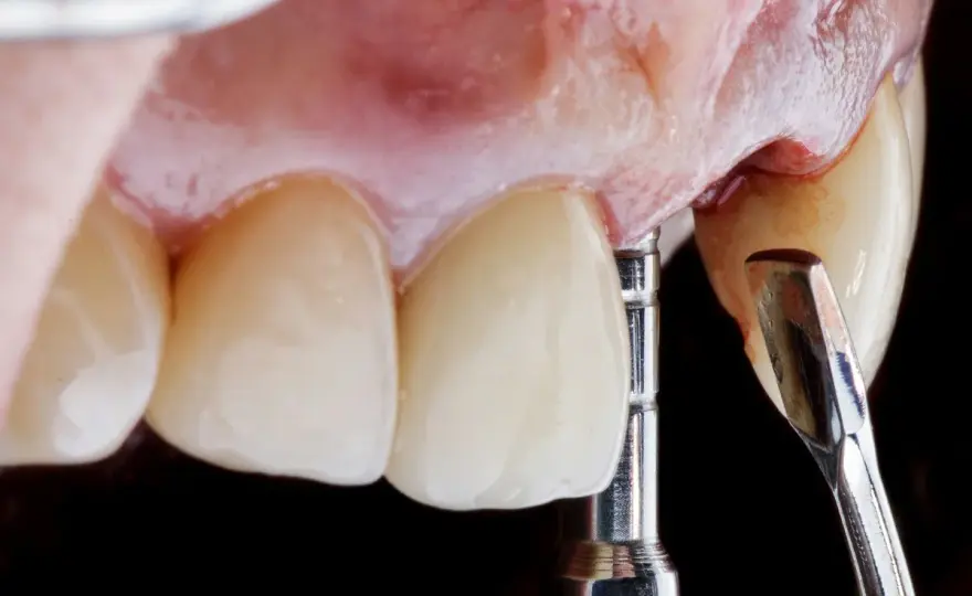 Impianto dentale provvisorio - Guida completa e costi