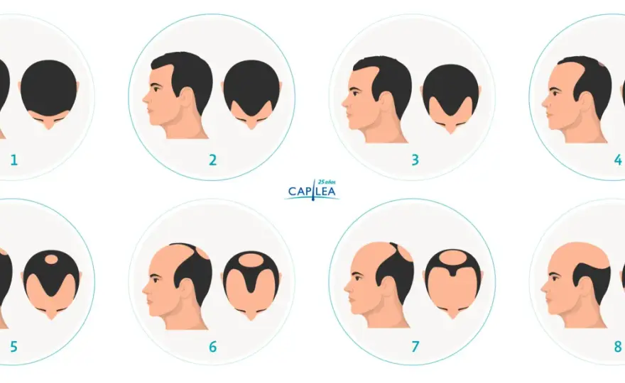 Densidad capilar - cómo saber qué está cambiando en tu pelo