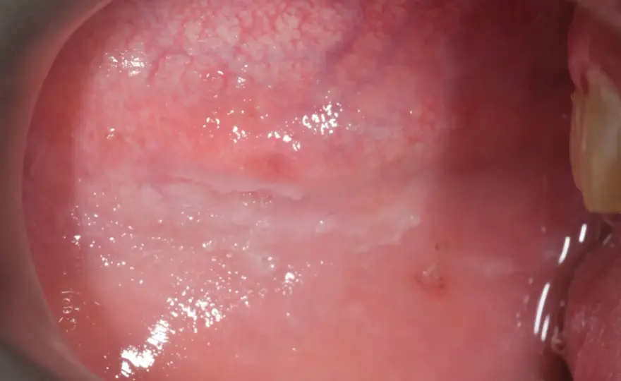 Morso guancia interna - Rimedi e quando serve il dentista