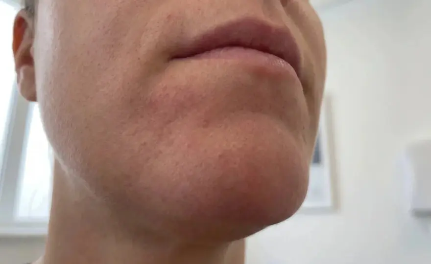 Perioral dermatit i klimakteriet - Lugna huden!