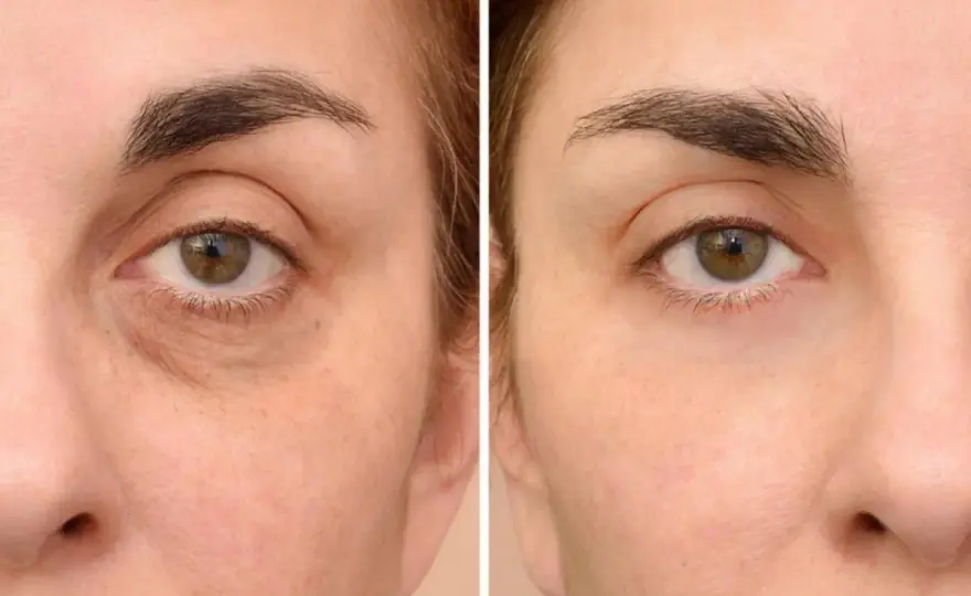 Cómo quitar las ojeras oscuras según su causa
